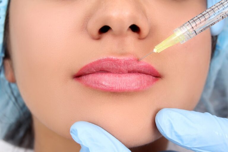 Understanding the Lip Filler Swelling Stages: What to Expect