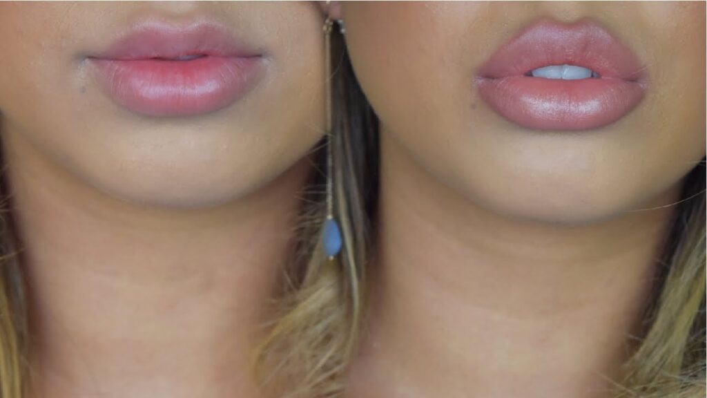 Understanding the Lip Filler Swelling Stages, Before and After