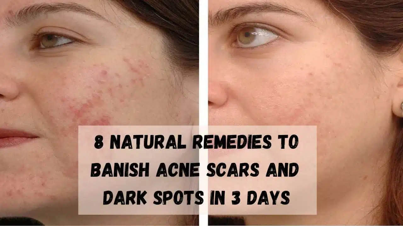 8-Natural-Remedies- to-Banish-Acne-Scars- and-Dark-Spots-in-3-Days